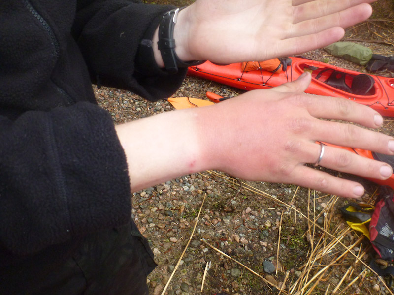 Kädet, joissa erottuu punainen kämmenselkä selkeästi valkoisesta ranteen alueesta.